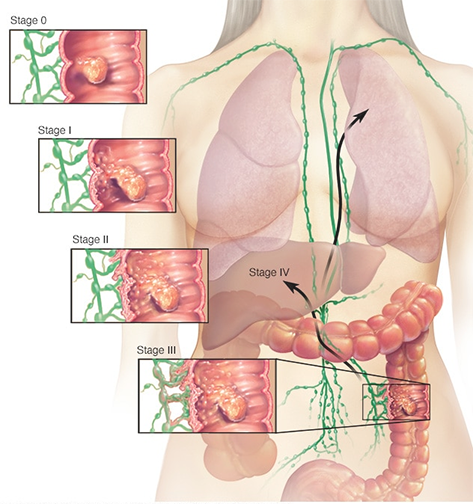 Colon Cancer Signs