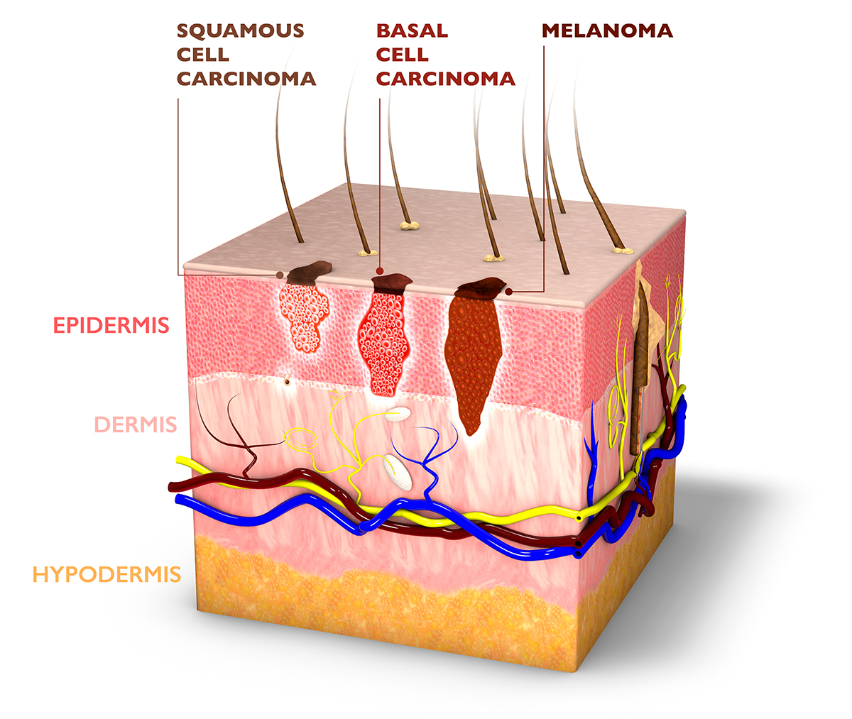 Skin Cancer
